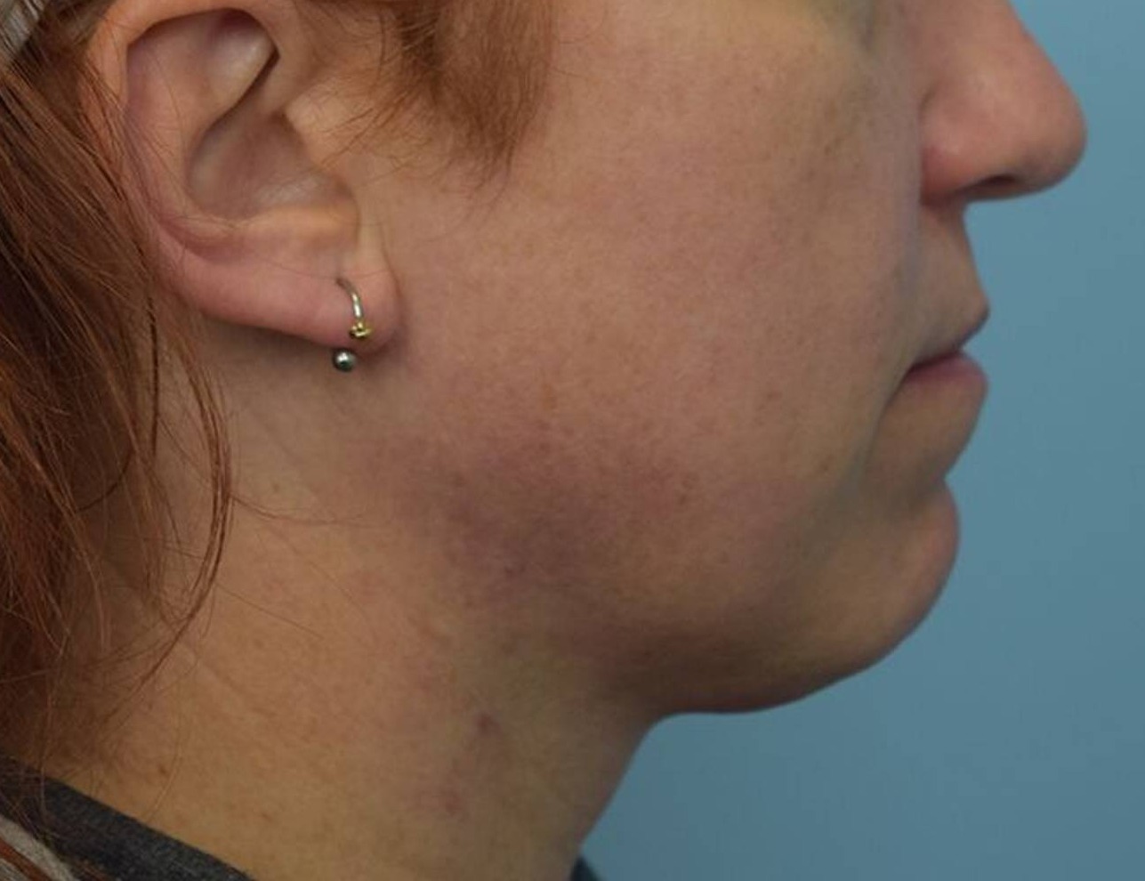 Augmentation Genioplasty Before & After Image