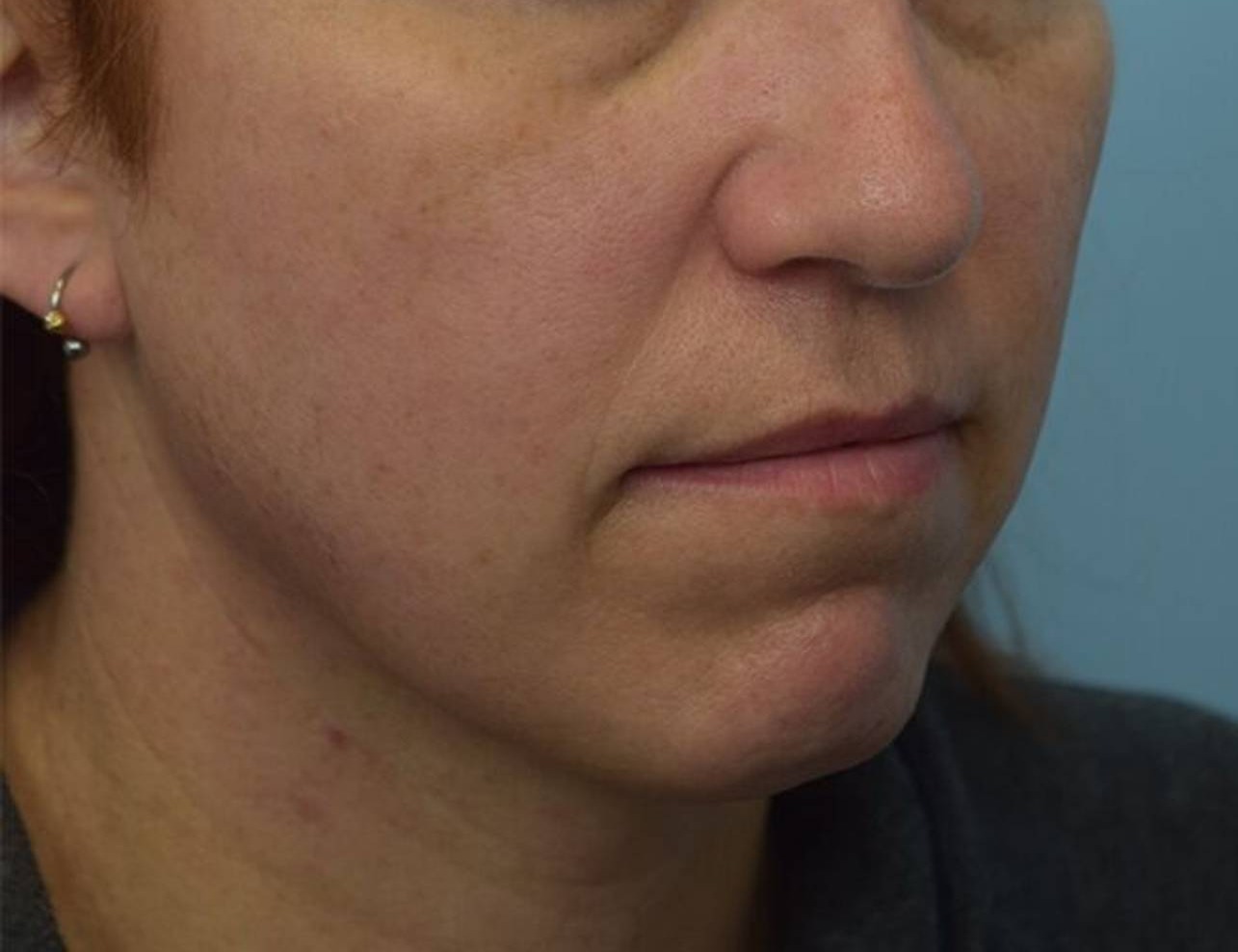 Augmentation Genioplasty Before & After Image