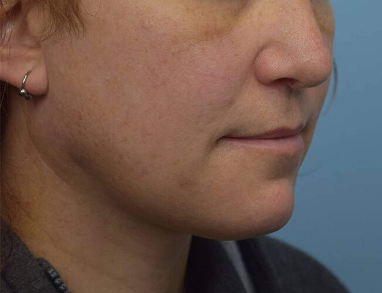 Augmentation Genioplasty Before & After Image