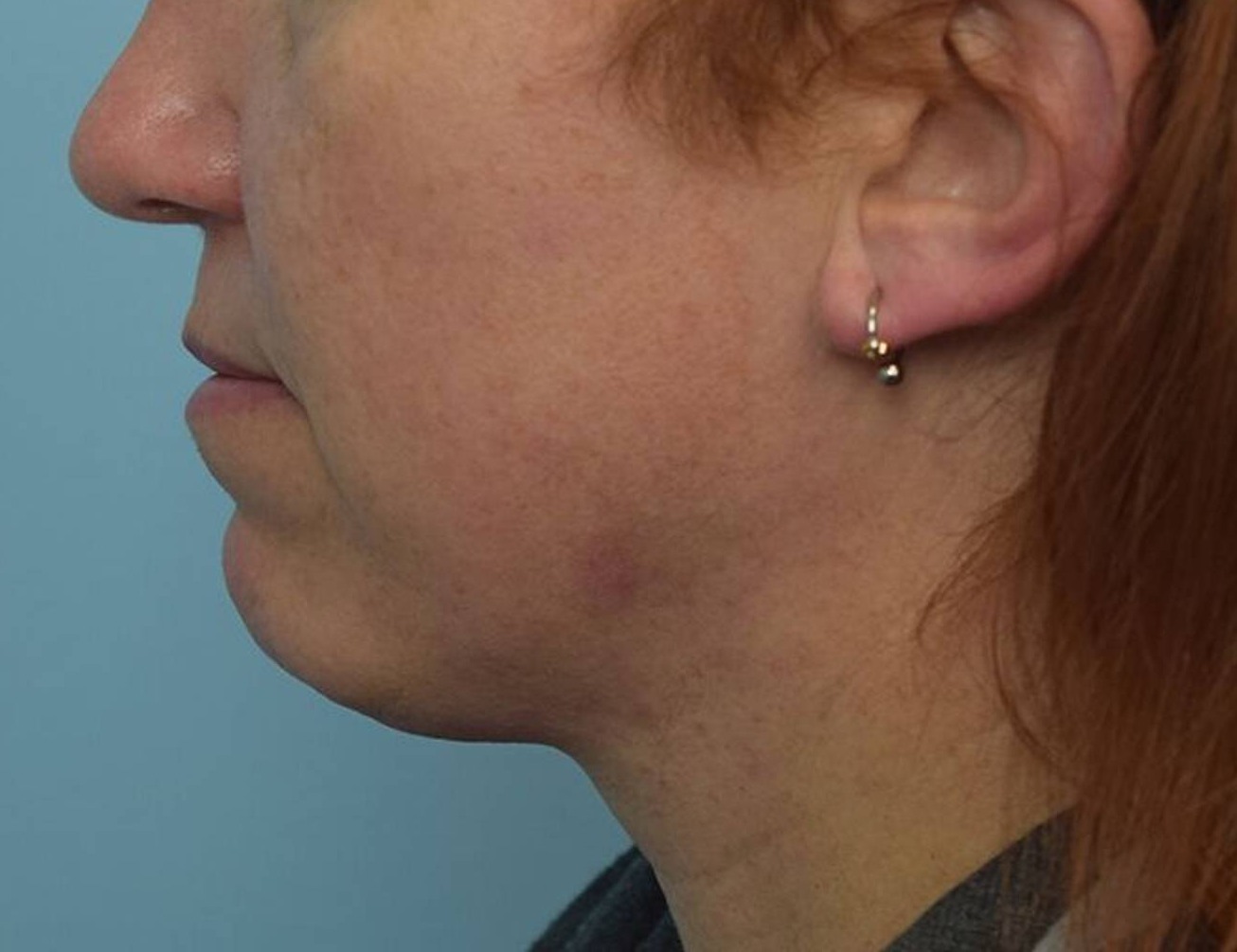 Augmentation Genioplasty Before & After Image