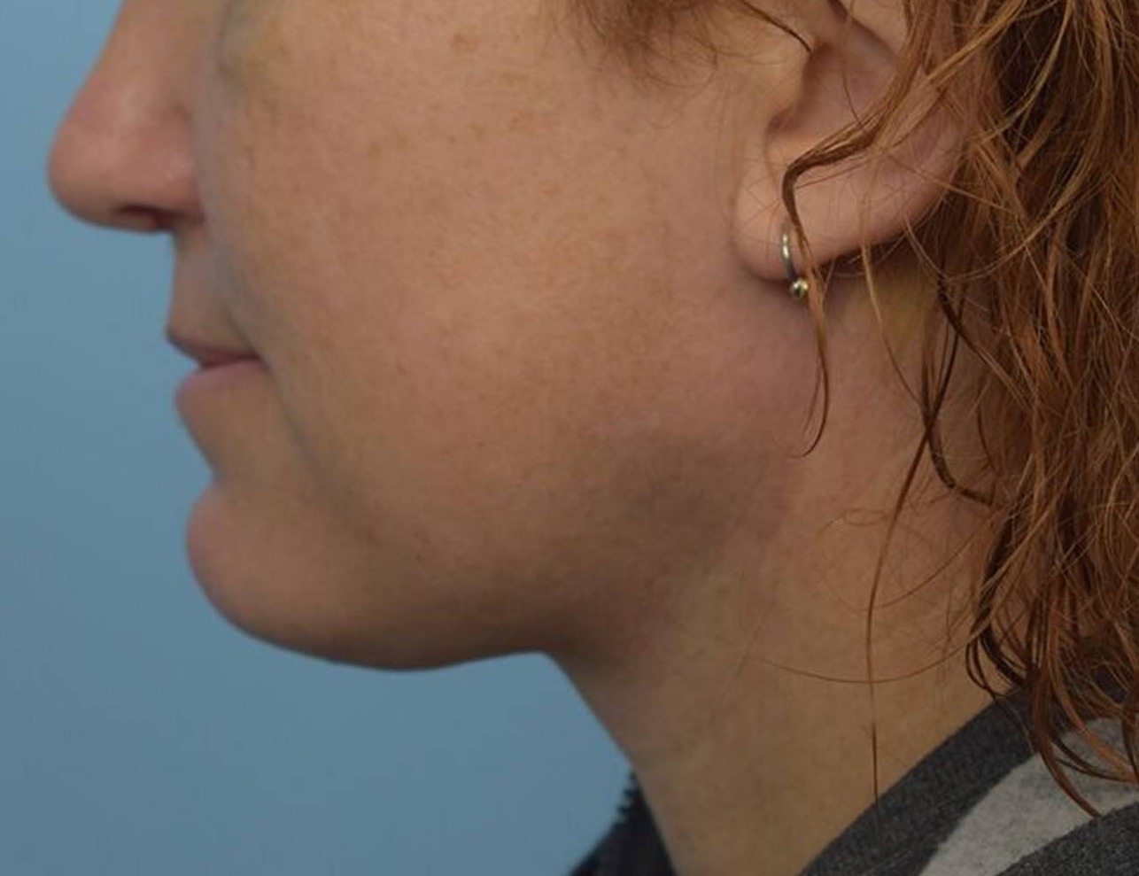 Augmentation Genioplasty Before & After Image