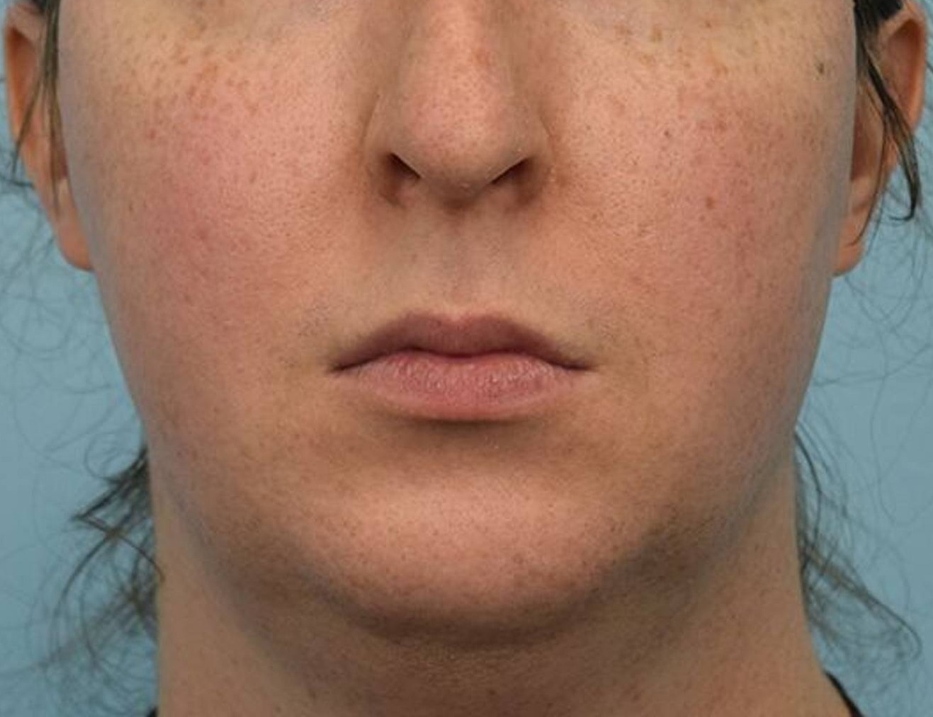 Augmentation Genioplasty Before & After Image