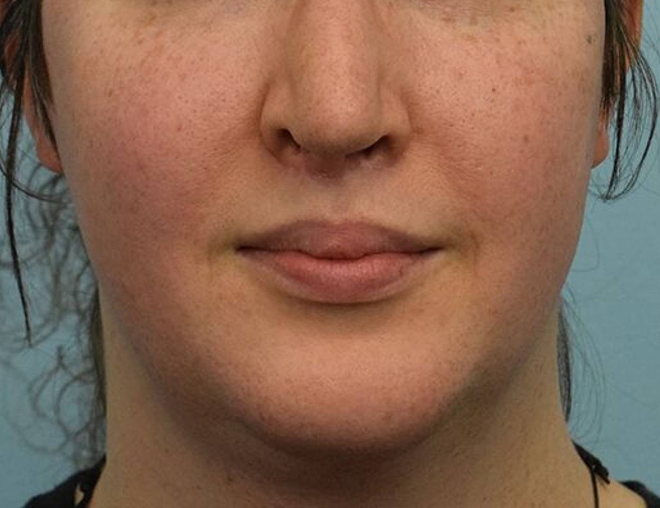 Augmentation Genioplasty Before & After Image