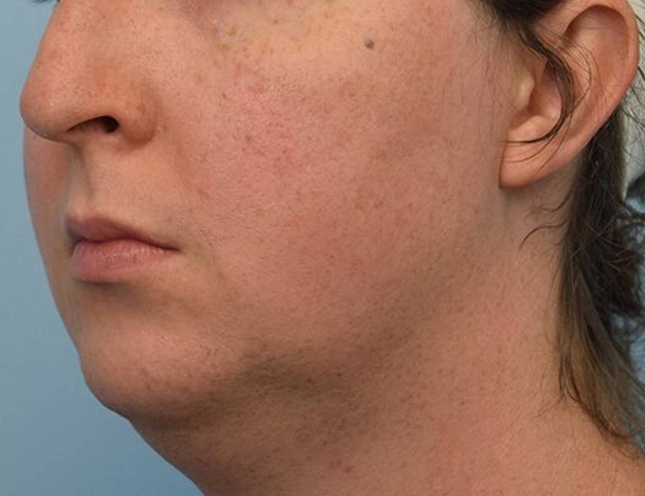 Augmentation Genioplasty Before & After Image