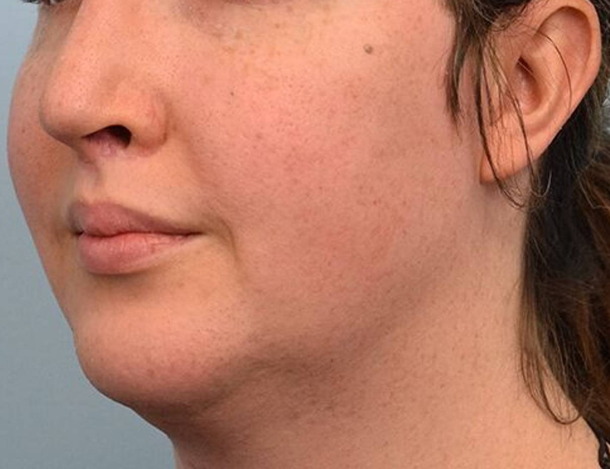 Augmentation Genioplasty Before & After Image