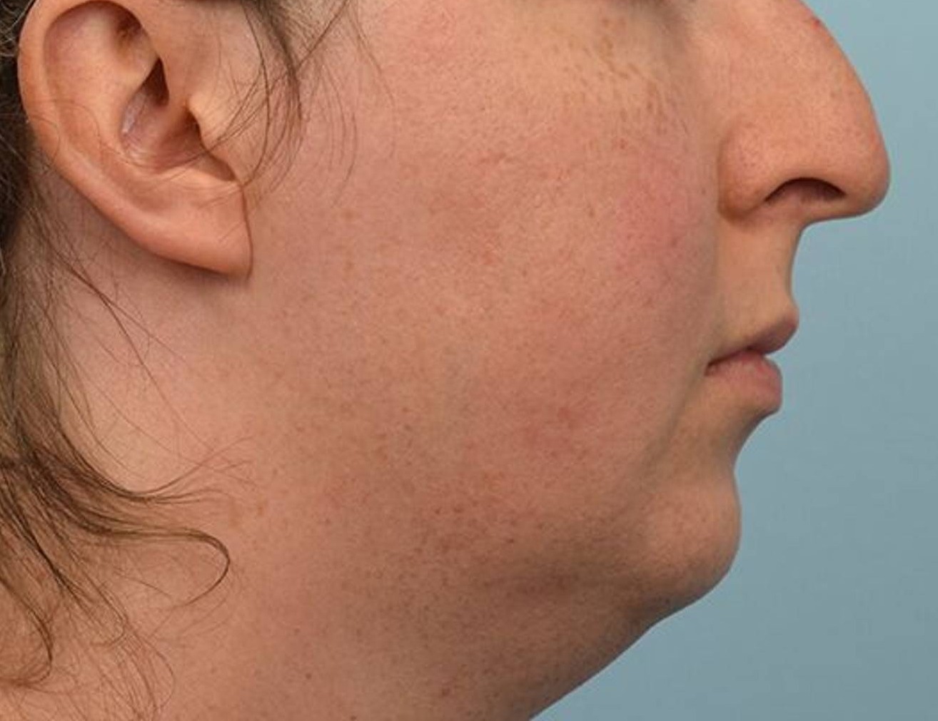 Augmentation Genioplasty Before & After Image