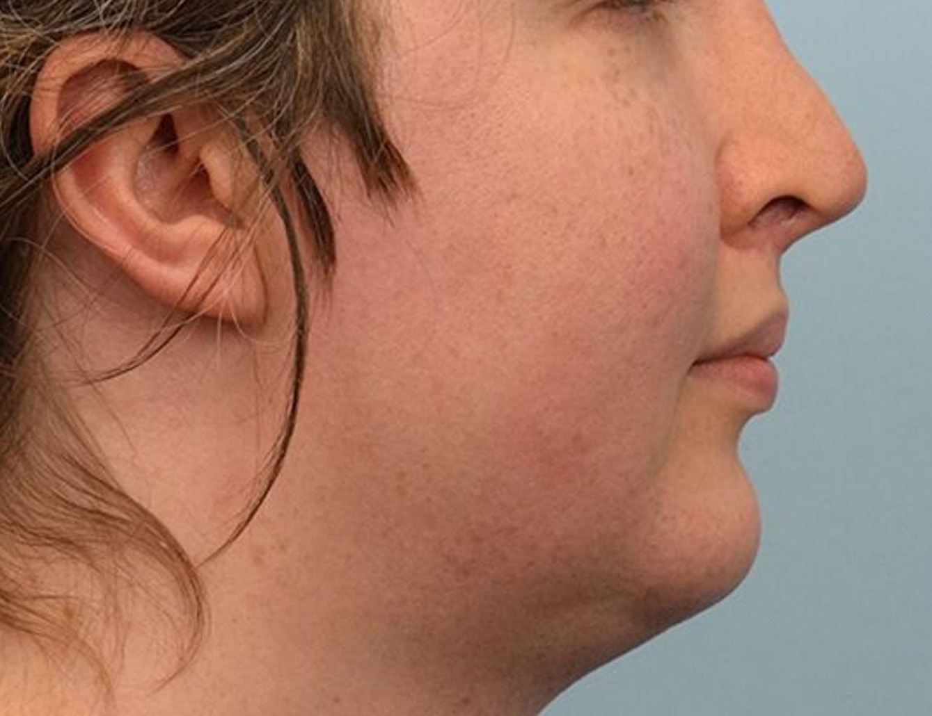 Augmentation Genioplasty Before & After Image