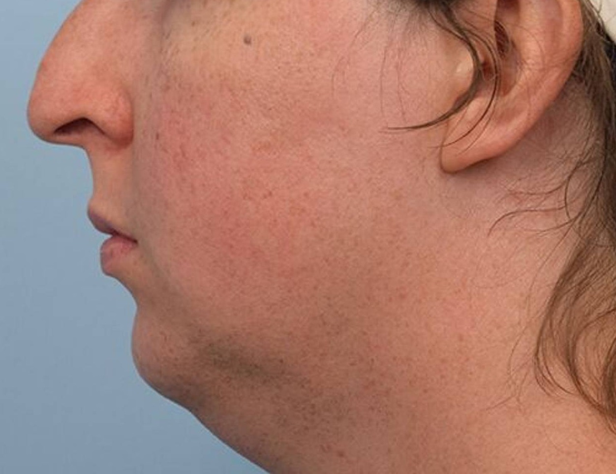 Augmentation Genioplasty Before & After Image