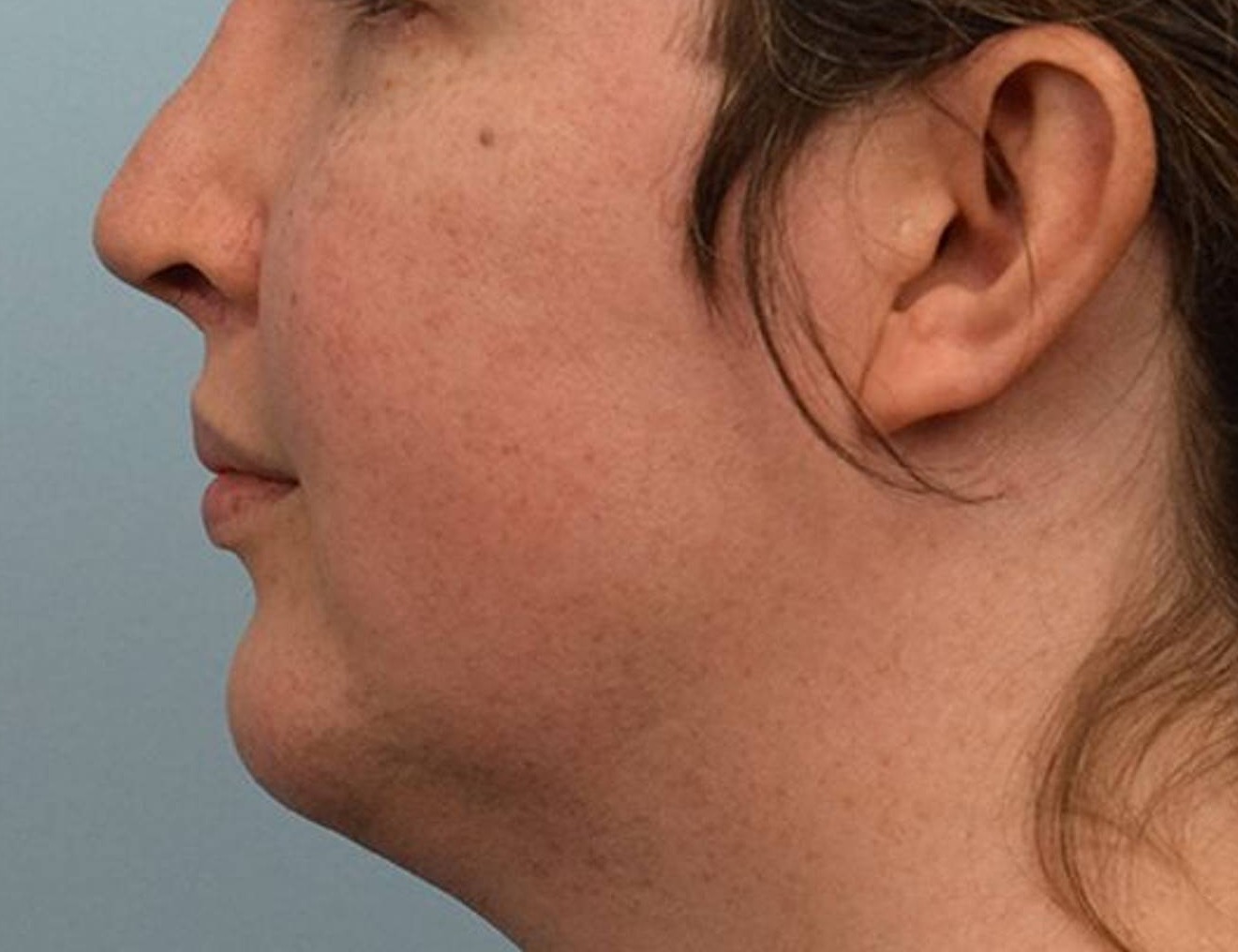 Augmentation Genioplasty Before & After Image