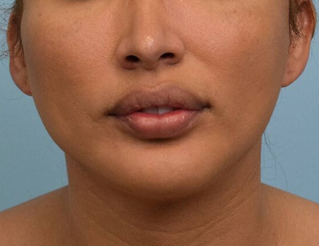Augmentation Genioplasty Before & After Image