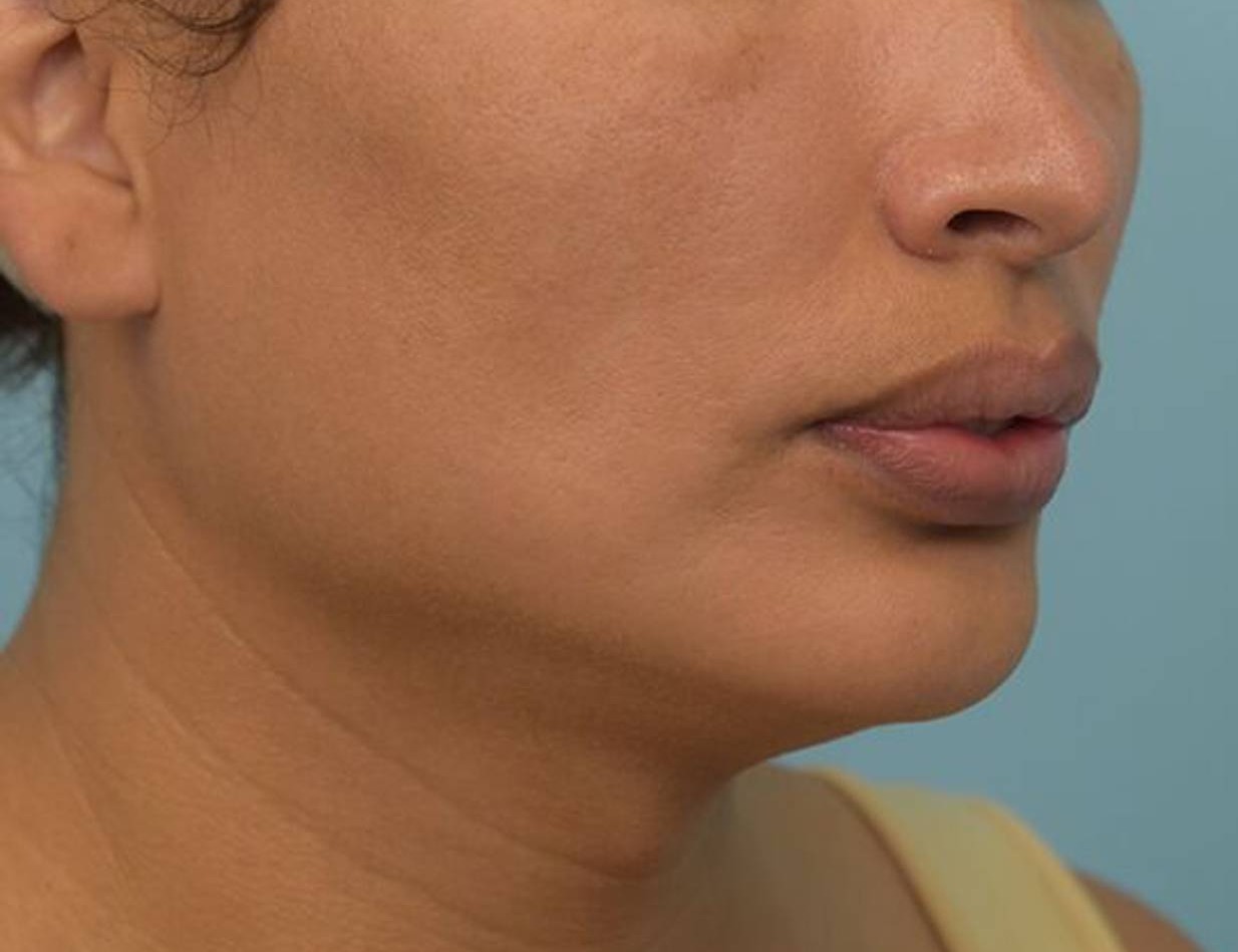 Augmentation Genioplasty Before & After Image