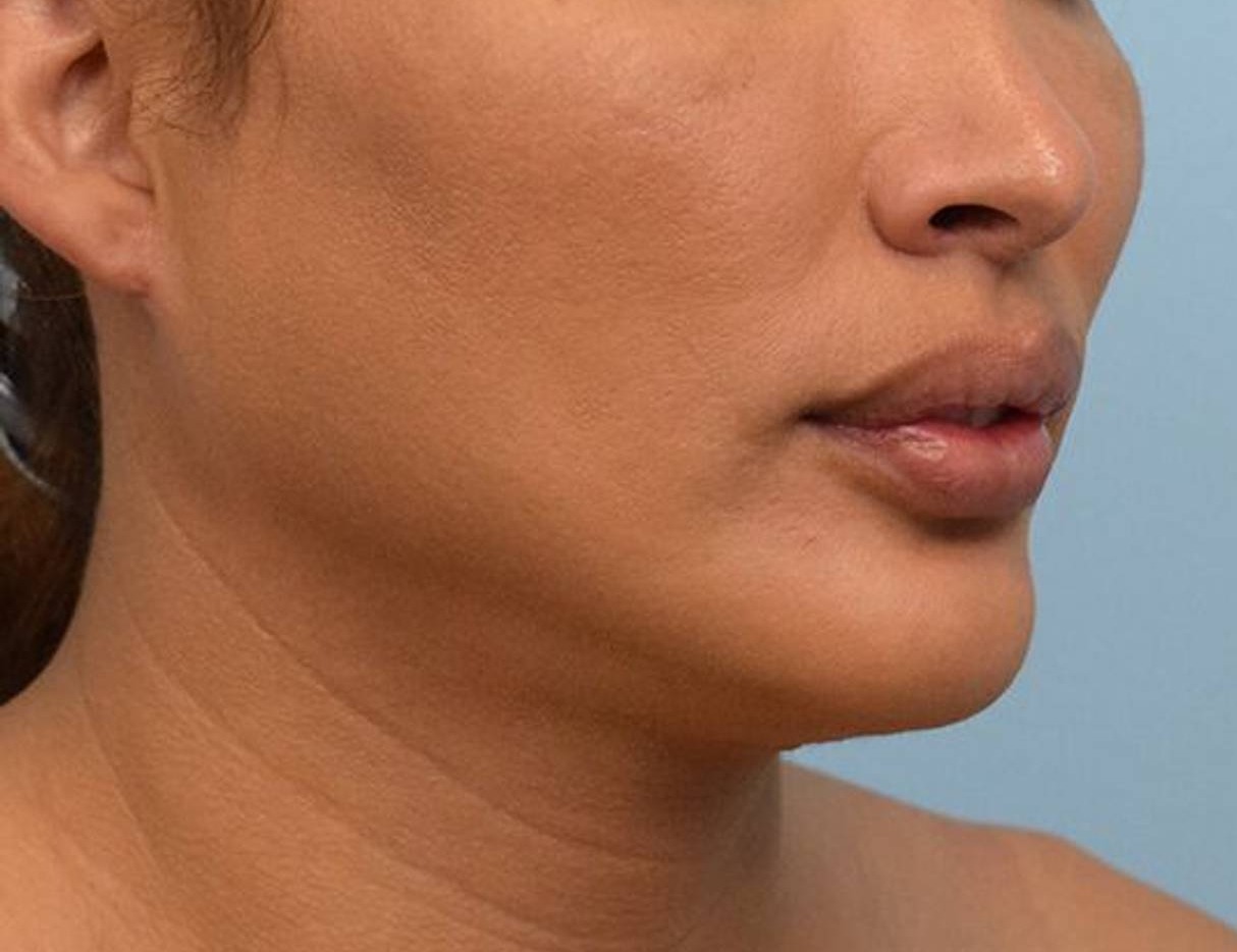 Augmentation Genioplasty Before & After Image