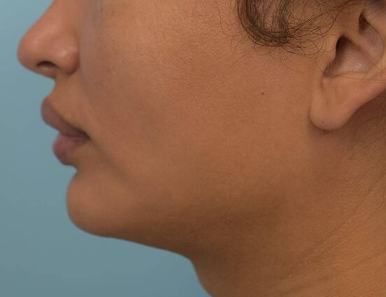 Augmentation Genioplasty Before & After Image