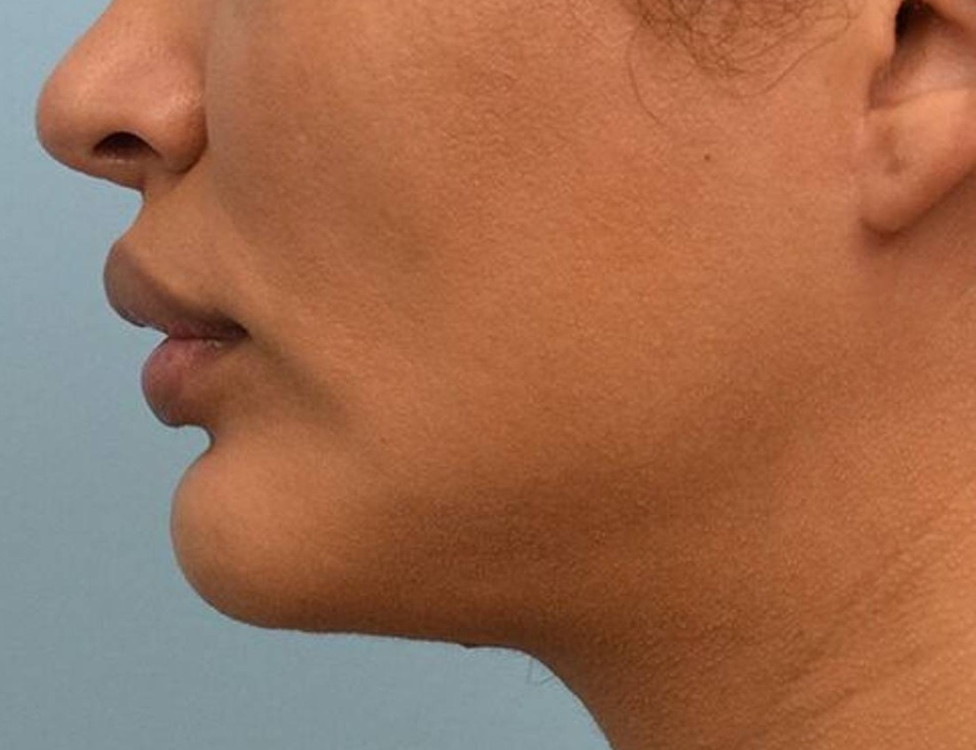 Augmentation Genioplasty Before & After Image