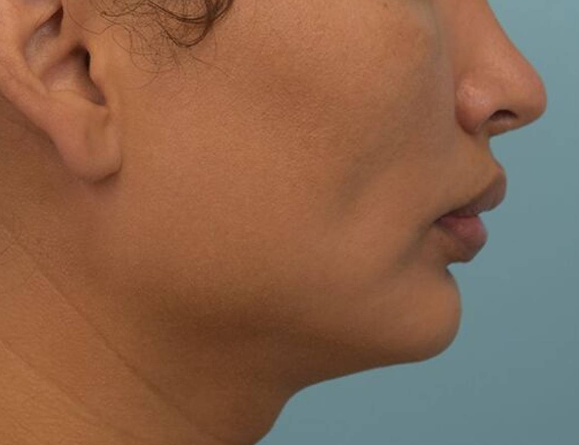 Augmentation Genioplasty Before & After Image