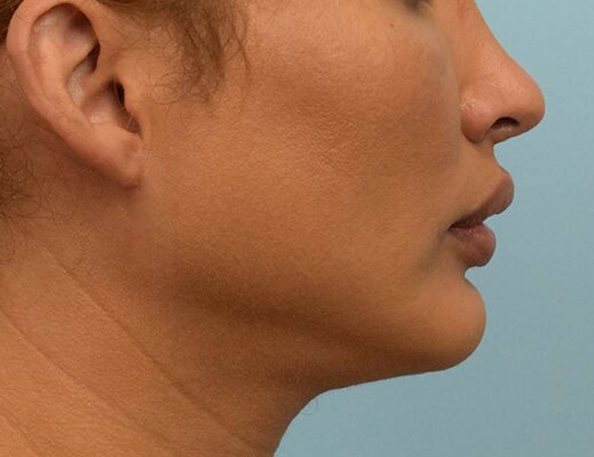 Augmentation Genioplasty Before & After Image