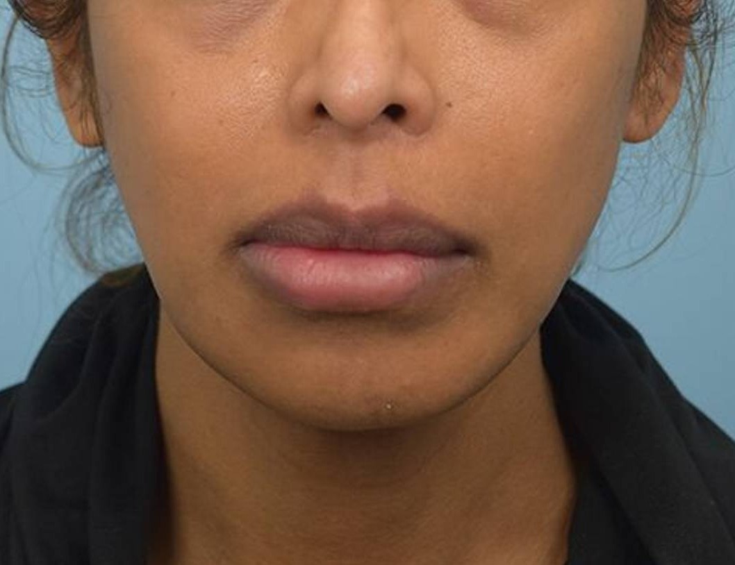Augmentation Genioplasty Before & After Image