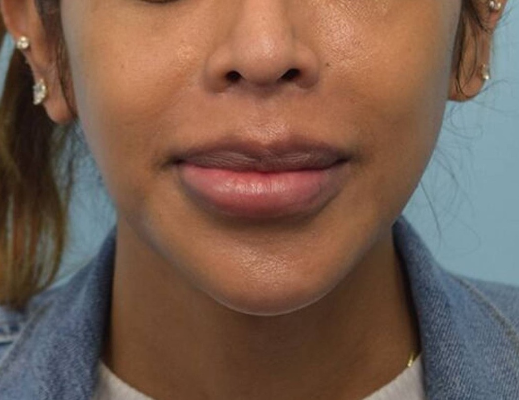 Augmentation Genioplasty Before & After Image