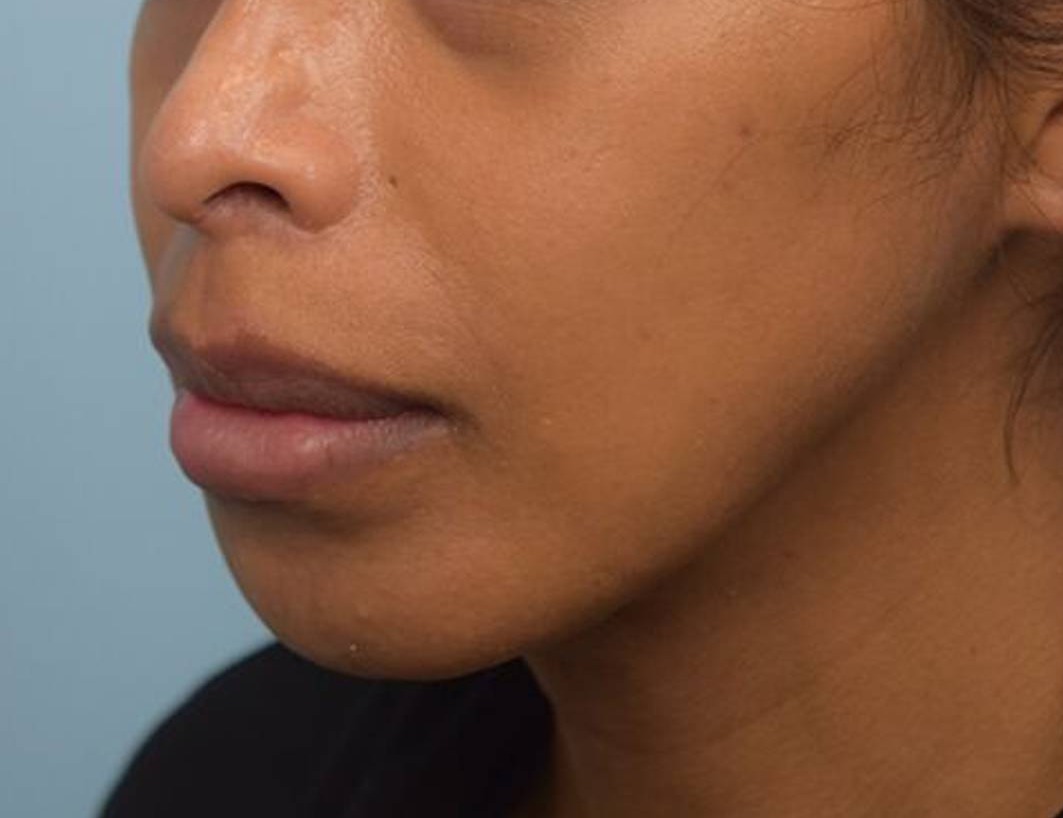 Augmentation Genioplasty Before & After Image