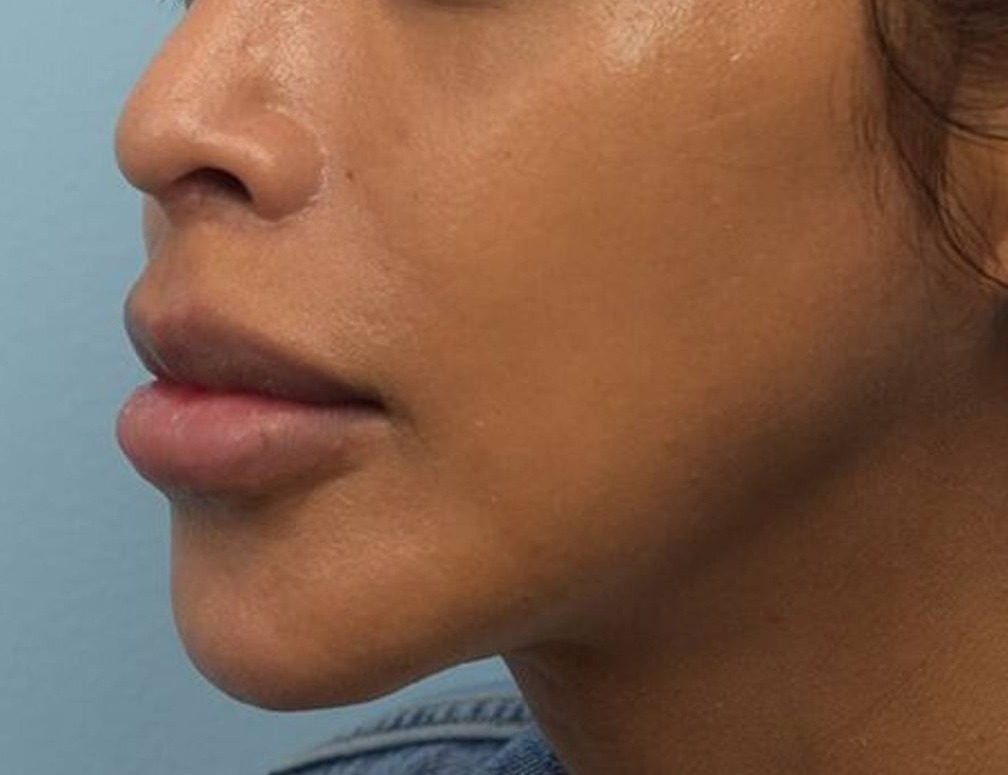 Augmentation Genioplasty Before & After Image