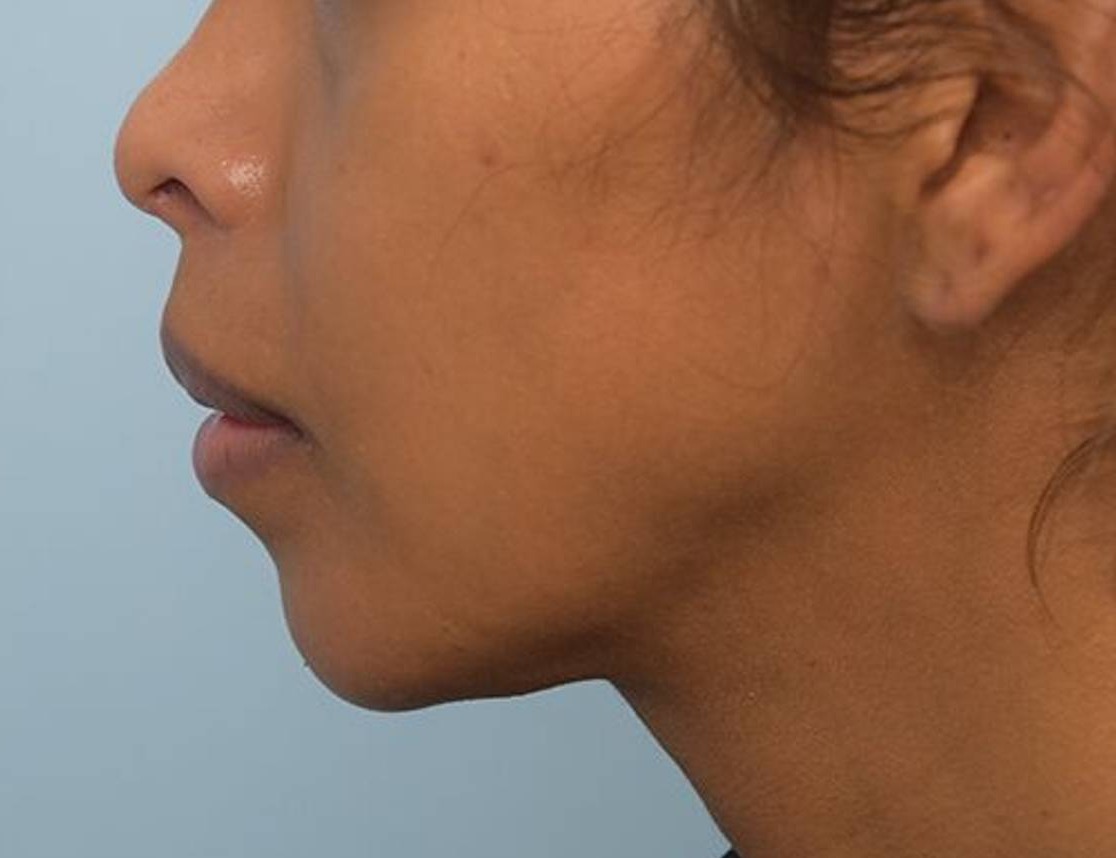 Augmentation Genioplasty Before & After Image