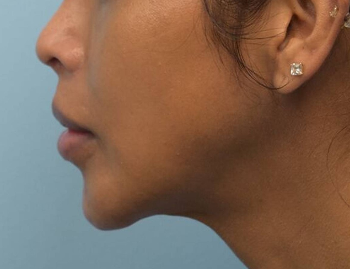 Augmentation Genioplasty Before & After Image