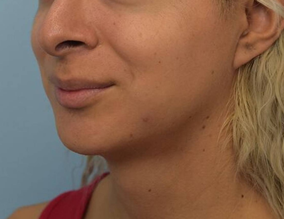 Augmentation Genioplasty Before & After Image