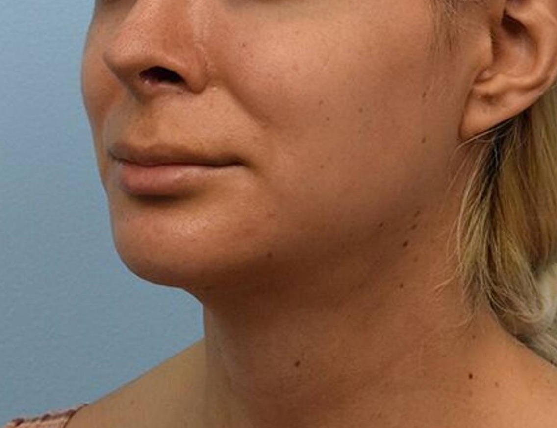 Augmentation Genioplasty Before & After Image