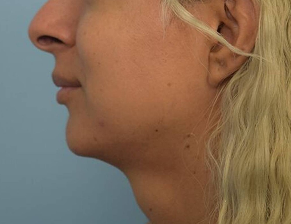 Augmentation Genioplasty Before & After Image