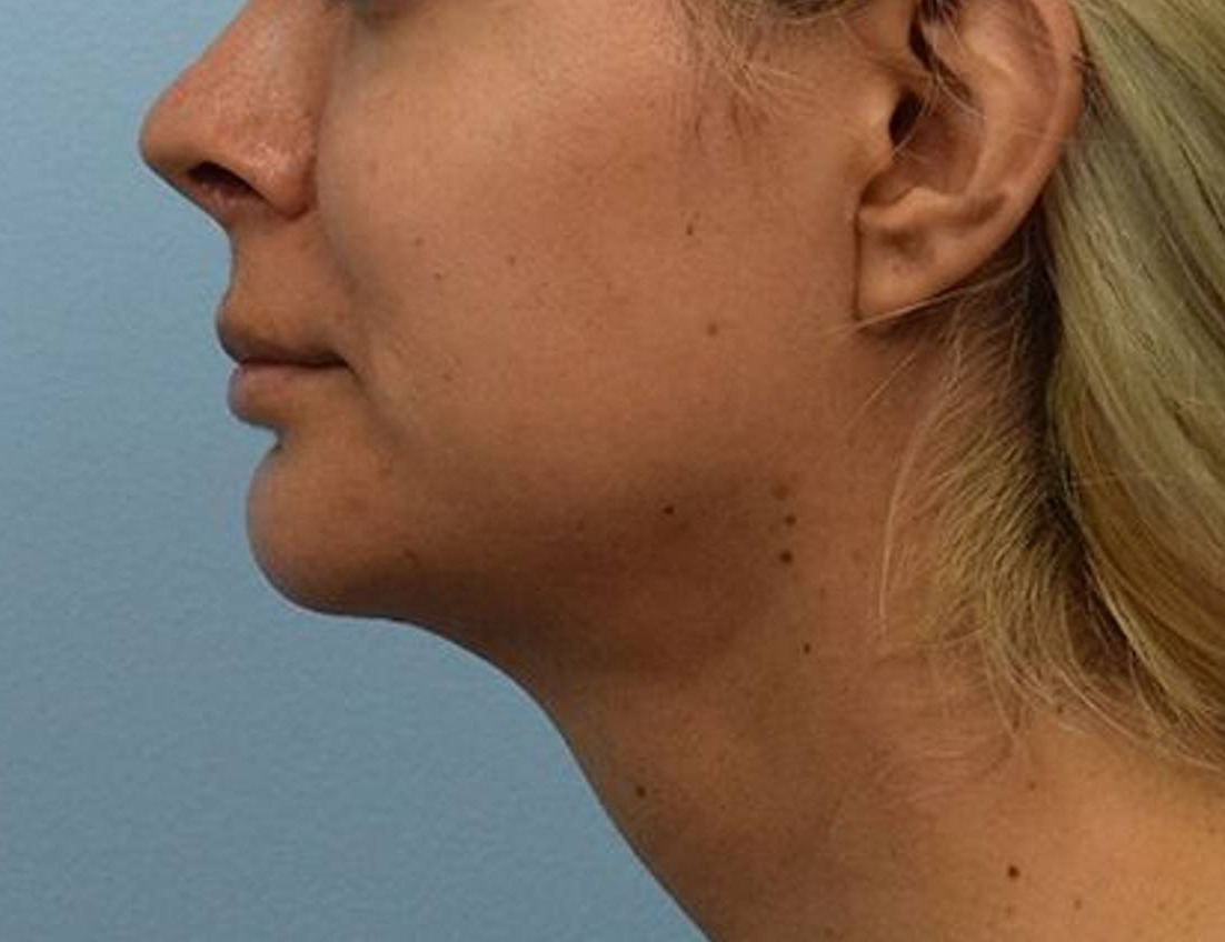 Augmentation Genioplasty Before & After Image