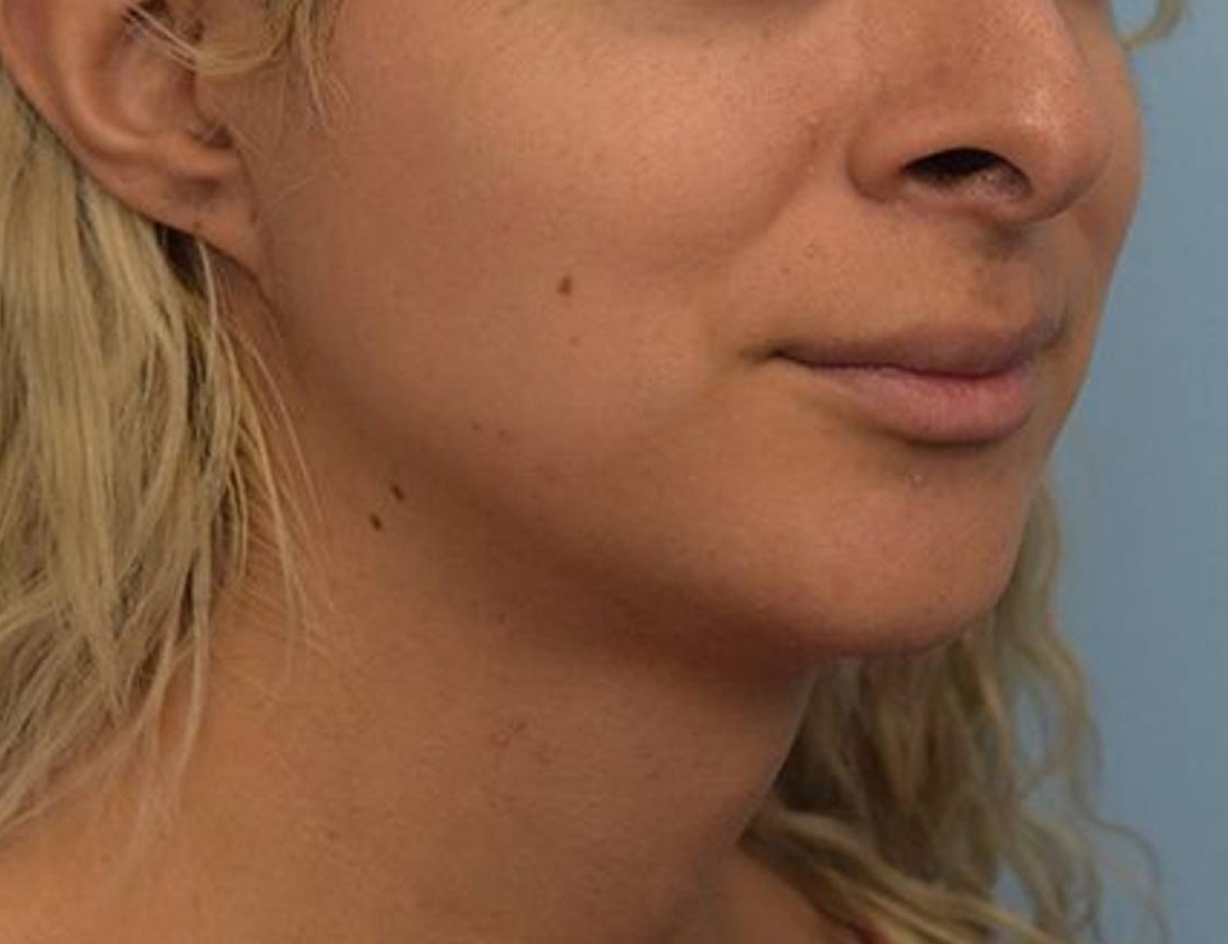 Augmentation Genioplasty Before & After Image