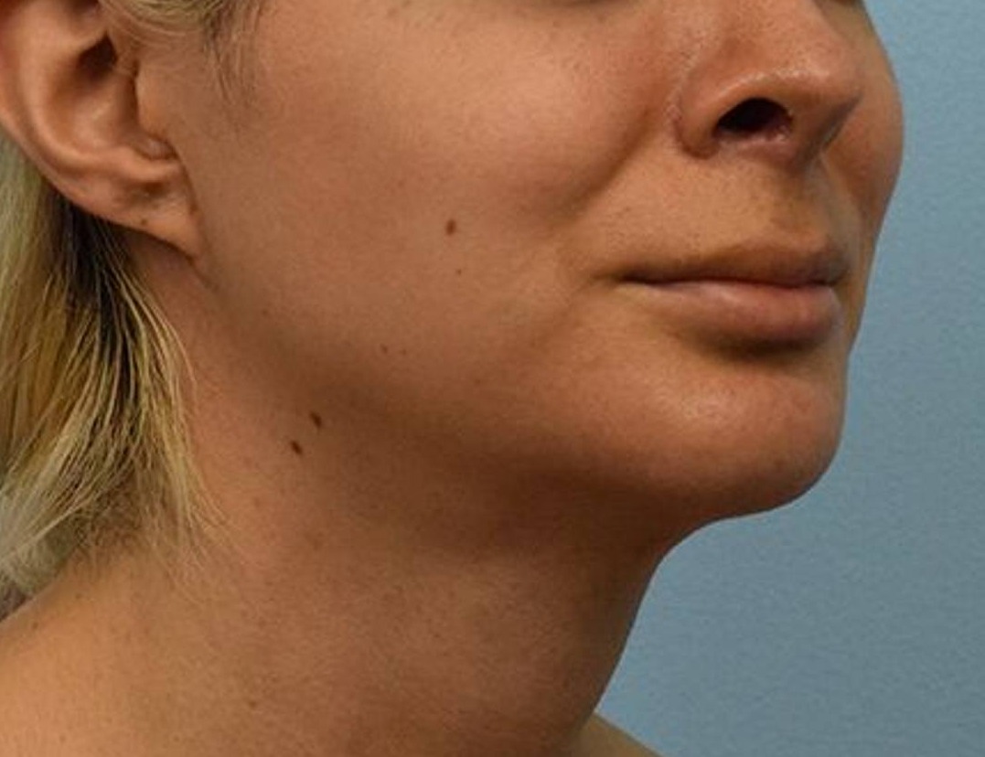 Augmentation Genioplasty Before & After Image
