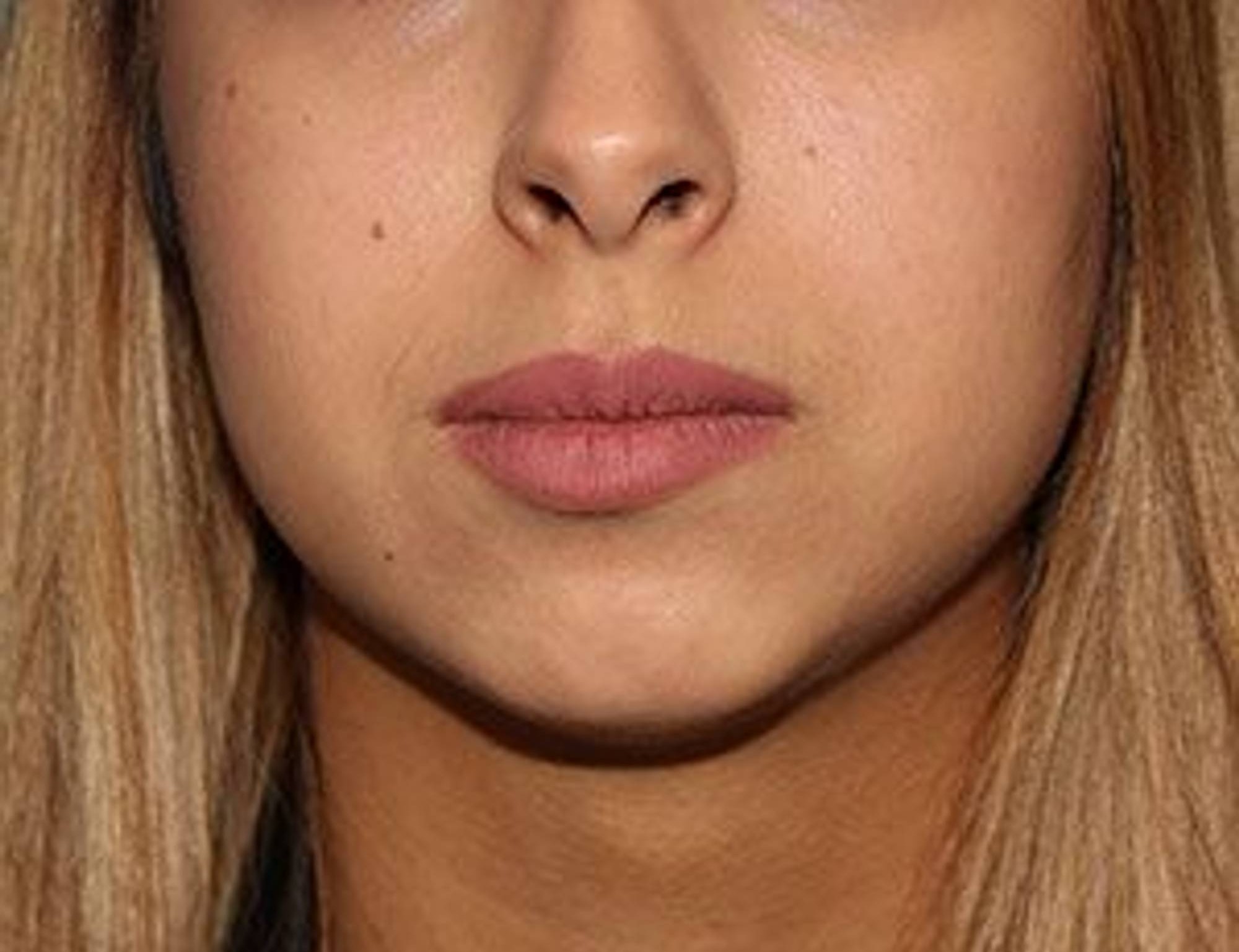 Augmentation Genioplasty Before & After Image