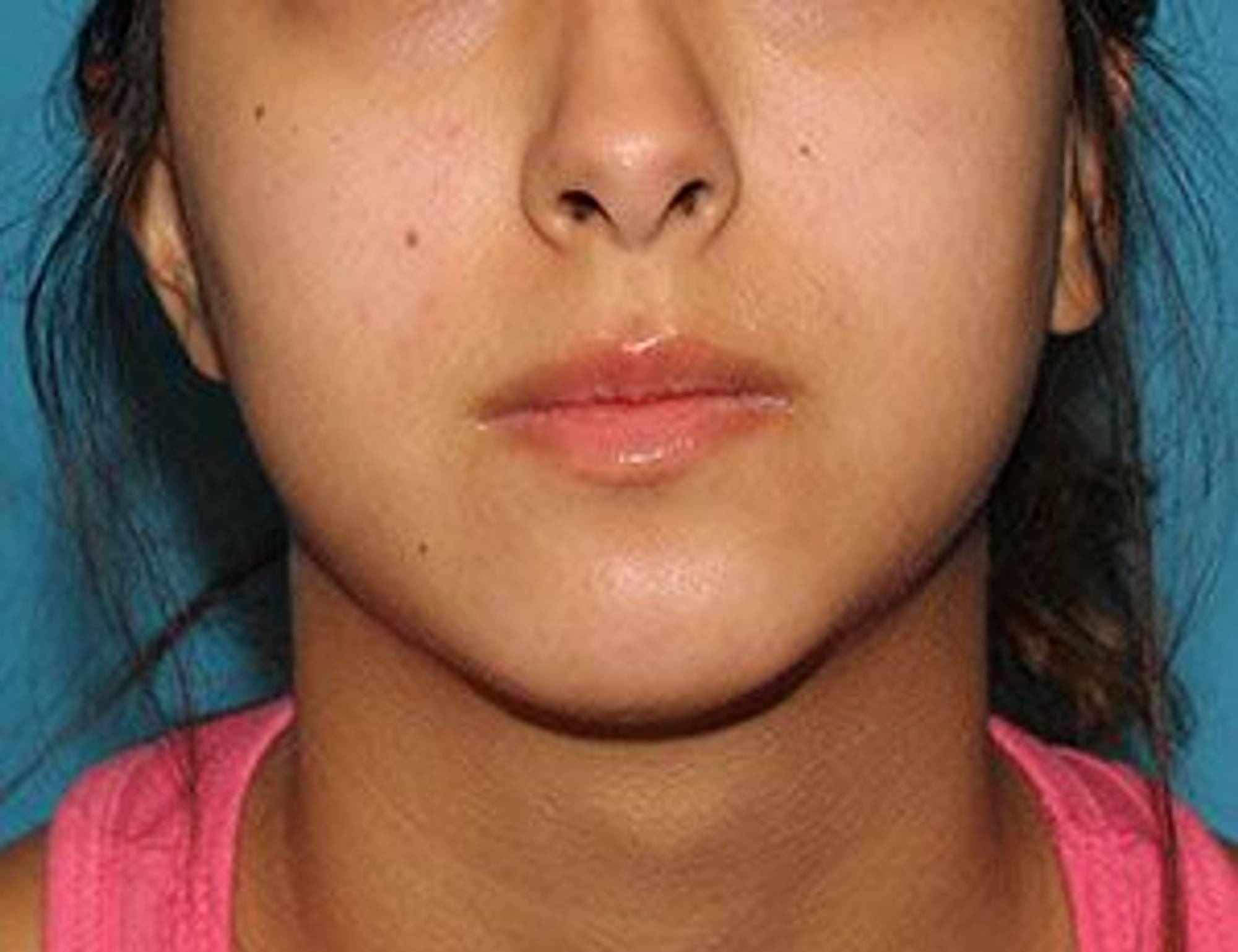 Augmentation Genioplasty Before & After Image
