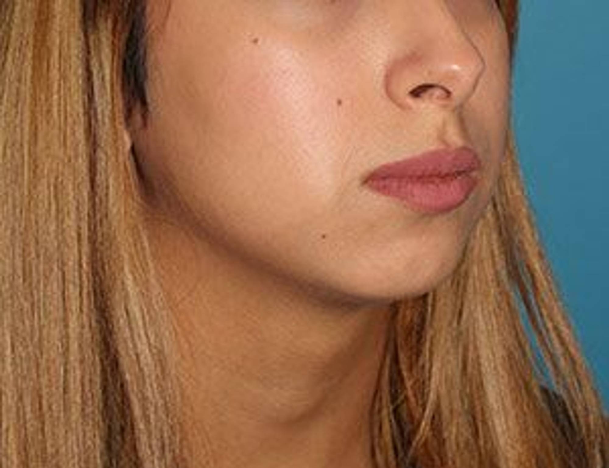 Augmentation Genioplasty Before & After Image