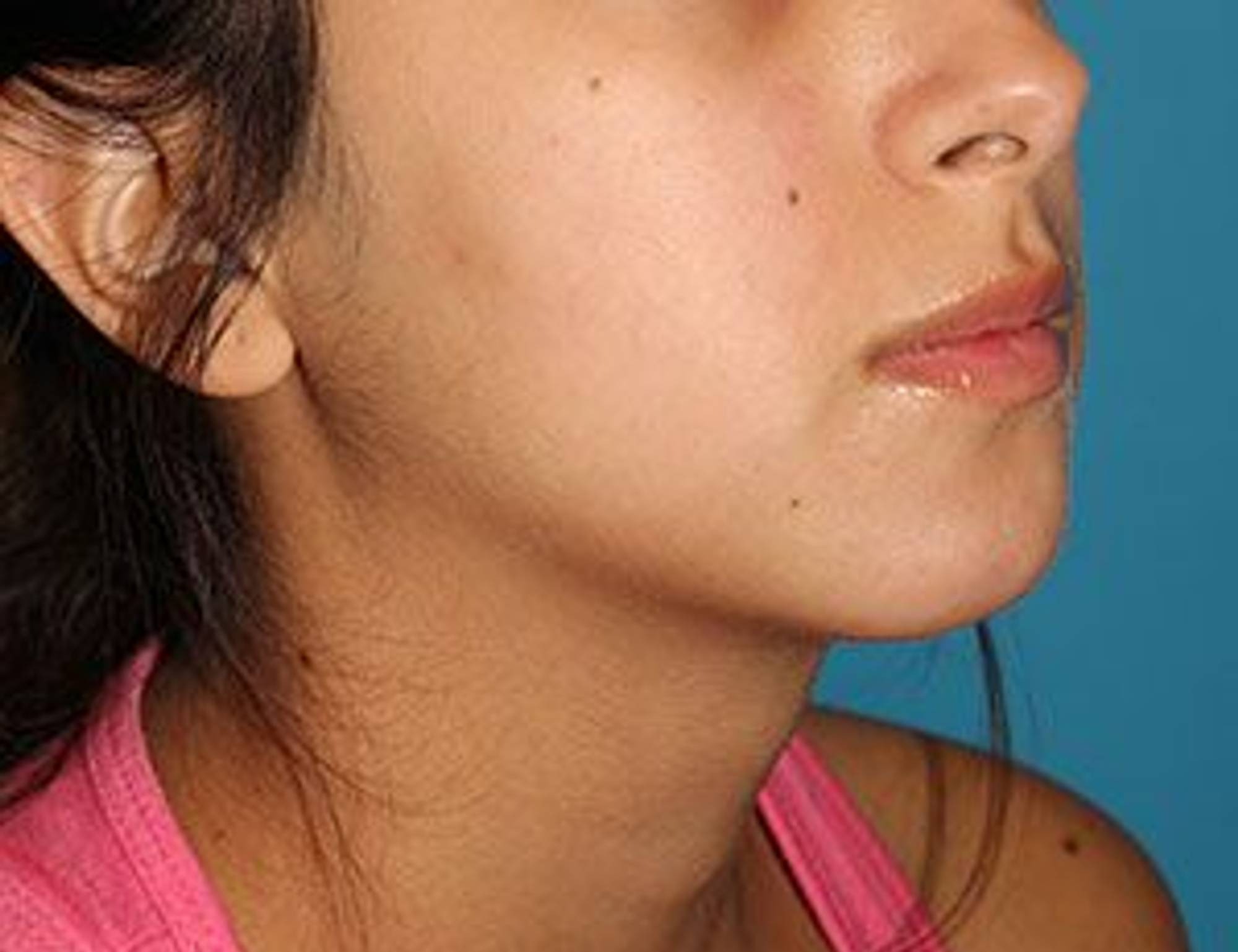 Augmentation Genioplasty Before & After Image