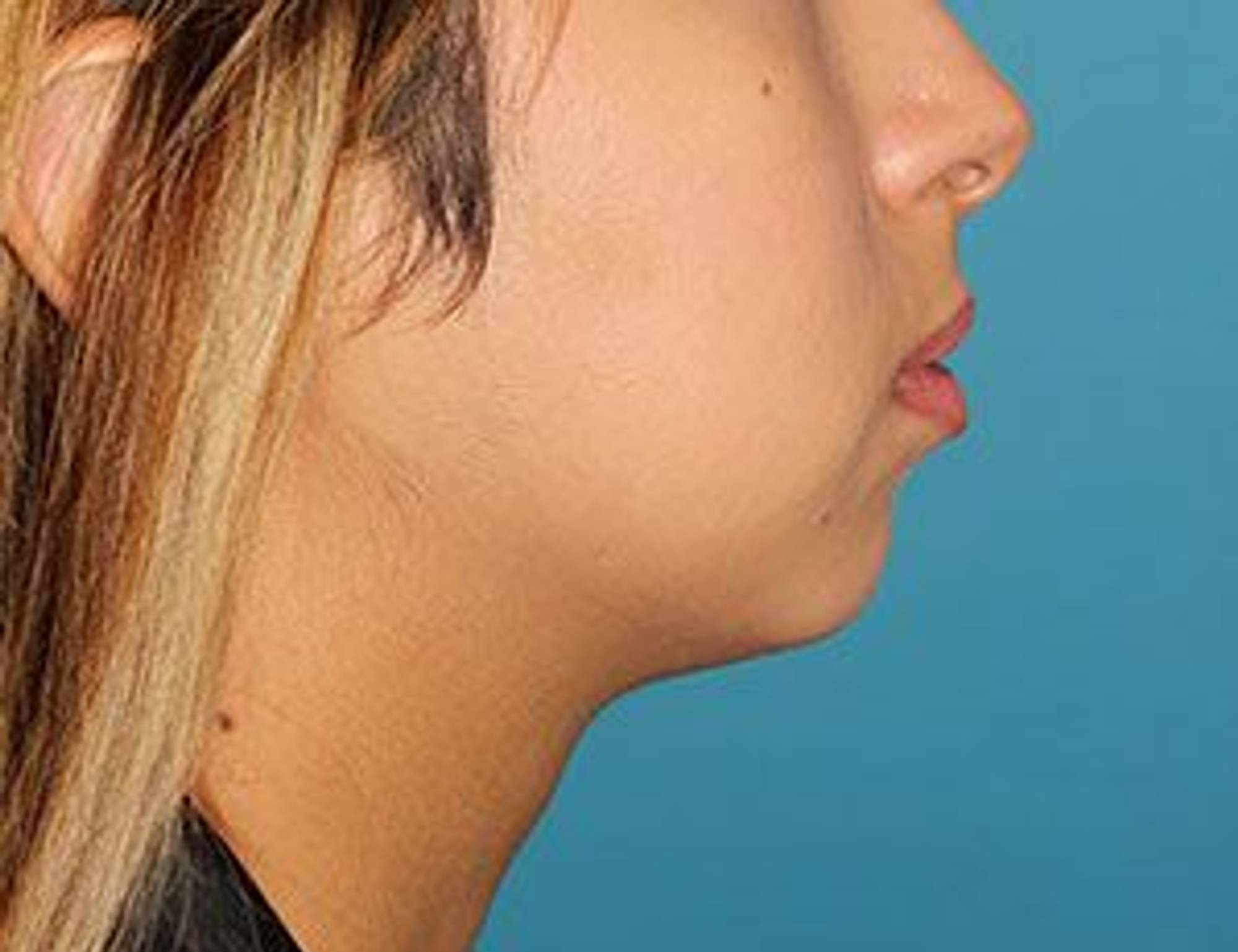Augmentation Genioplasty Before & After Image