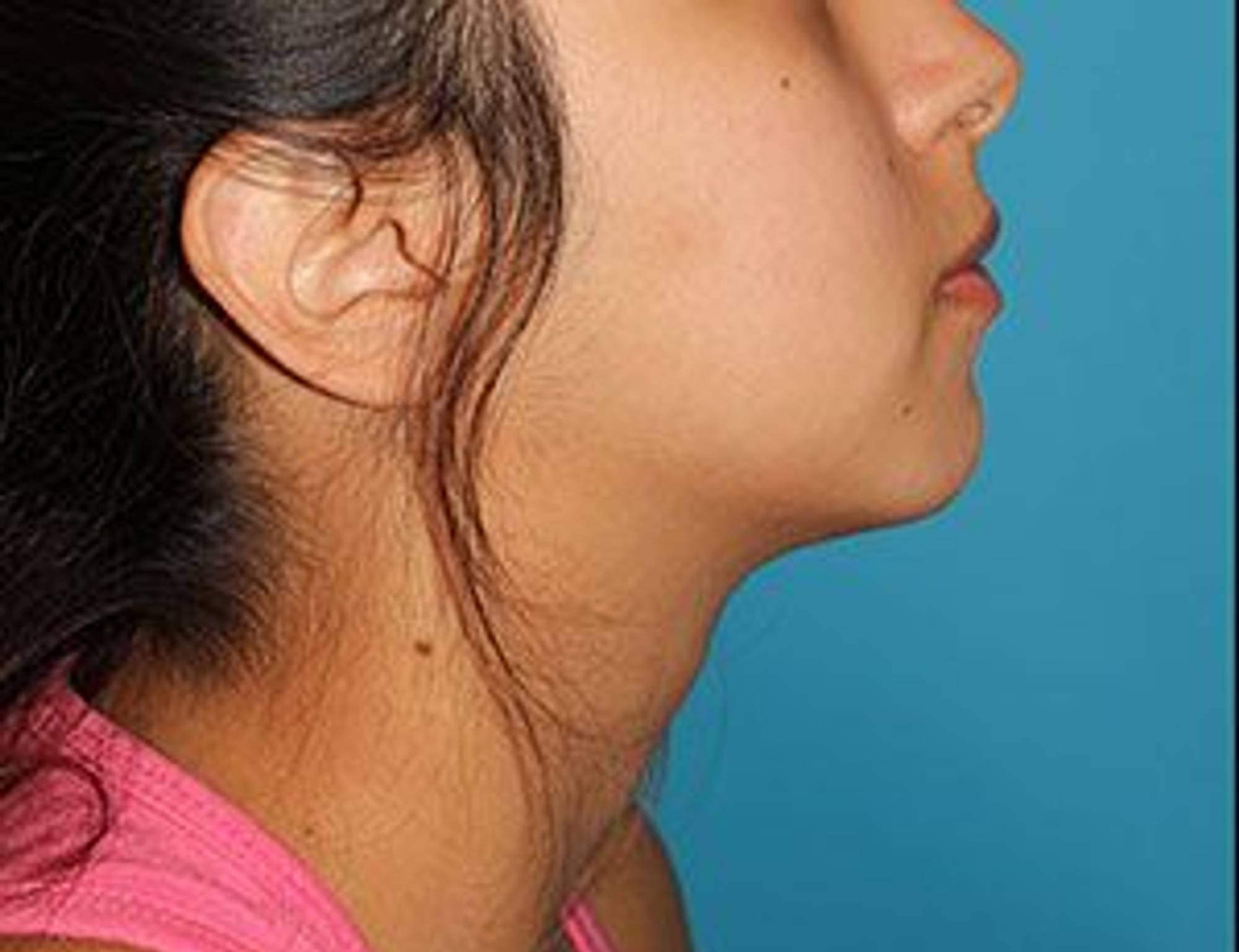 Augmentation Genioplasty Before & After Image
