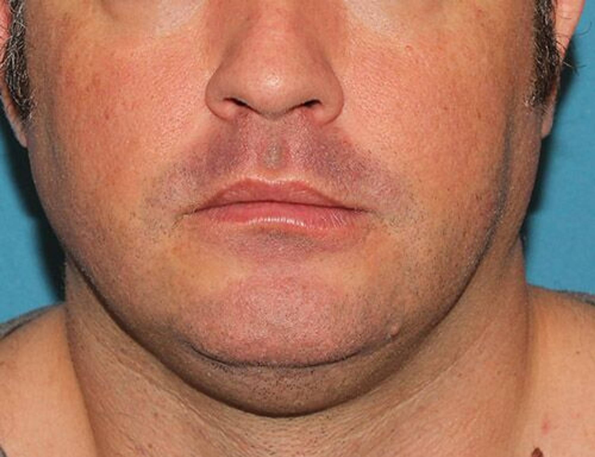 Augmentation Genioplasty Before & After Image