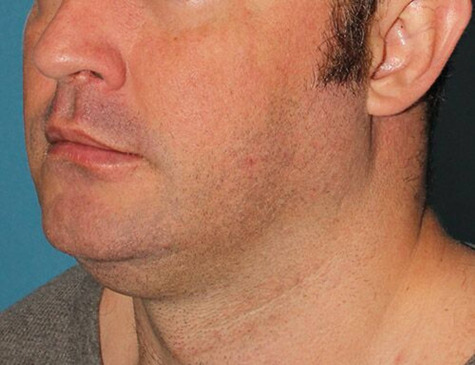 Augmentation Genioplasty Before & After Image