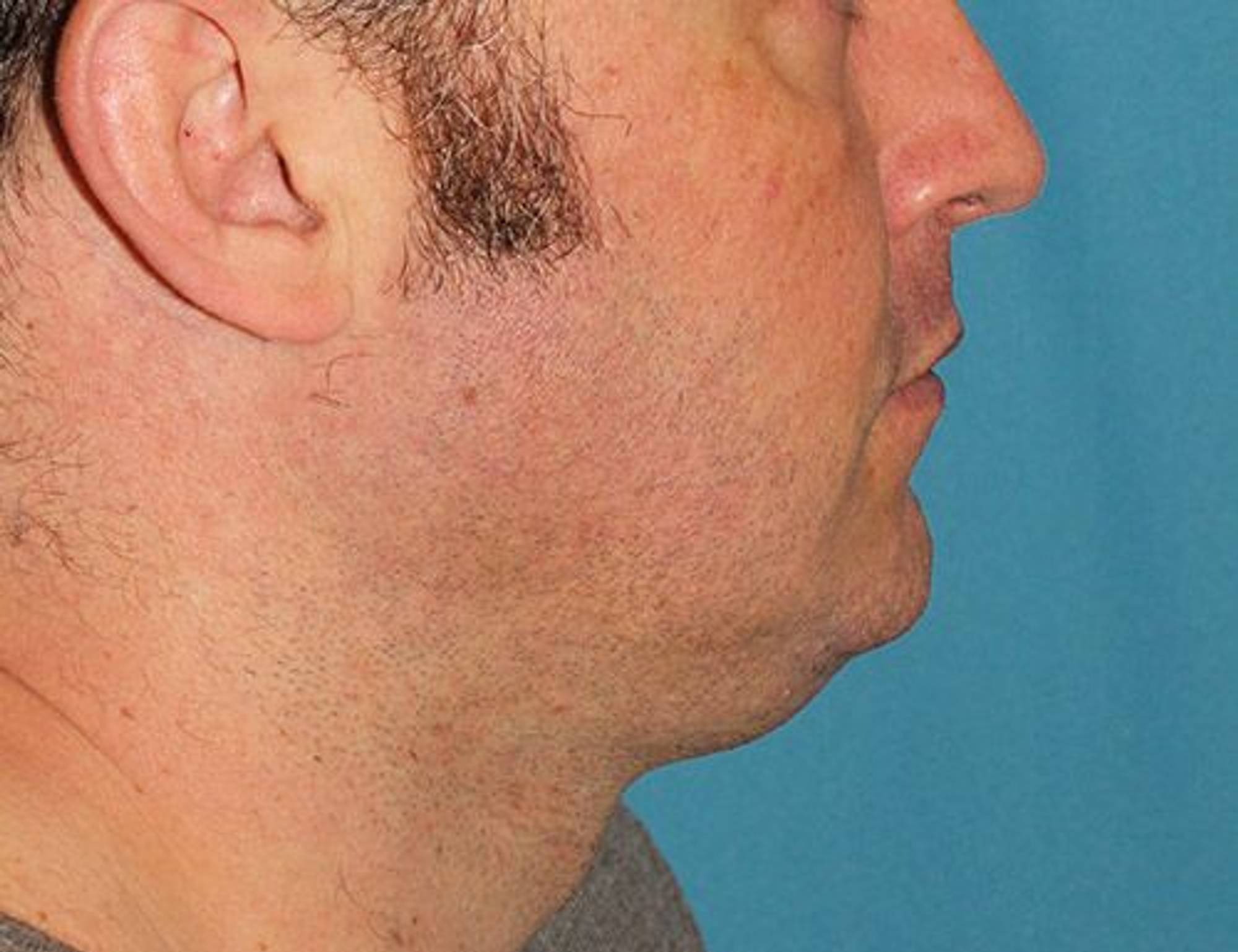 Augmentation Genioplasty Before & After Image