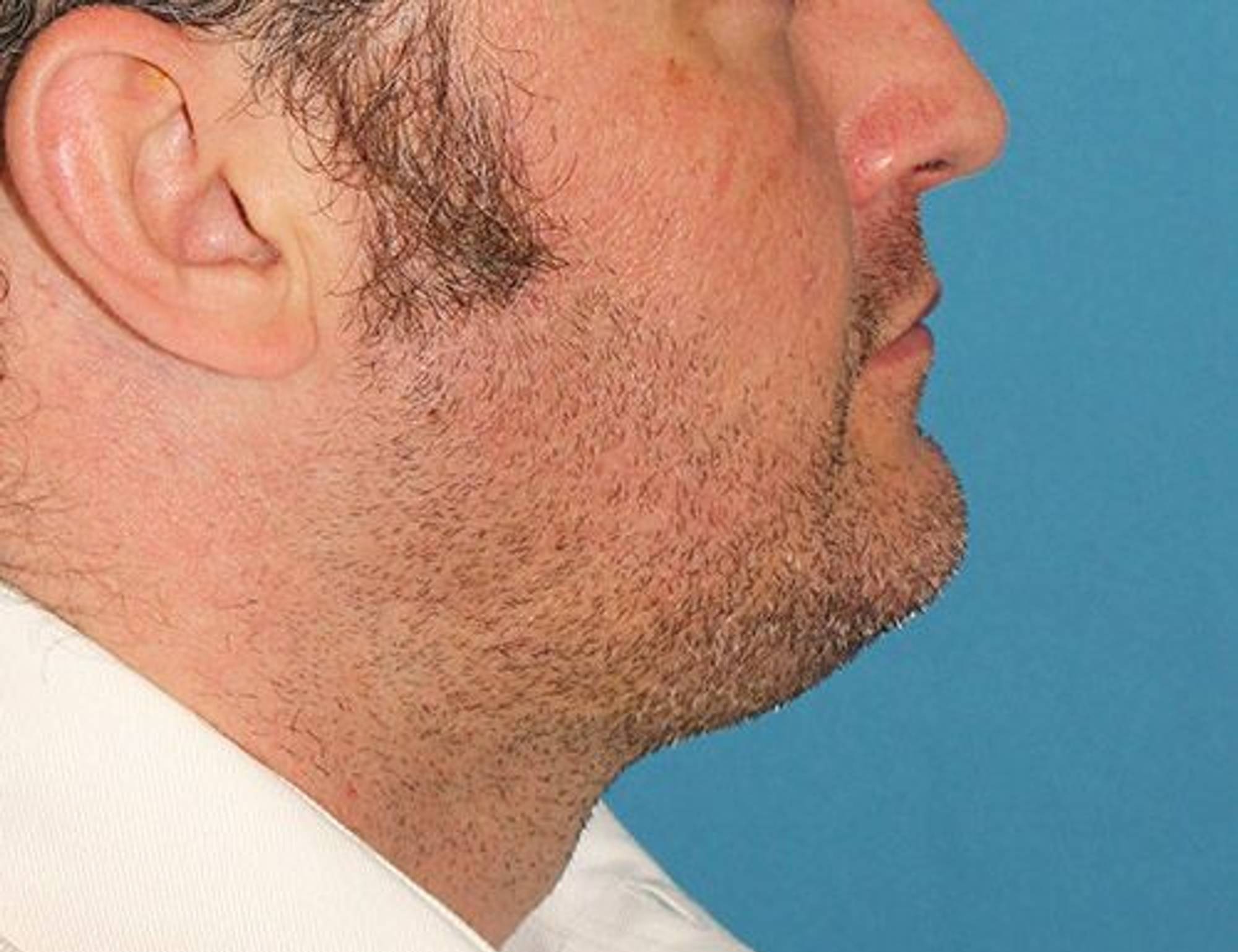 Augmentation Genioplasty Before & After Image