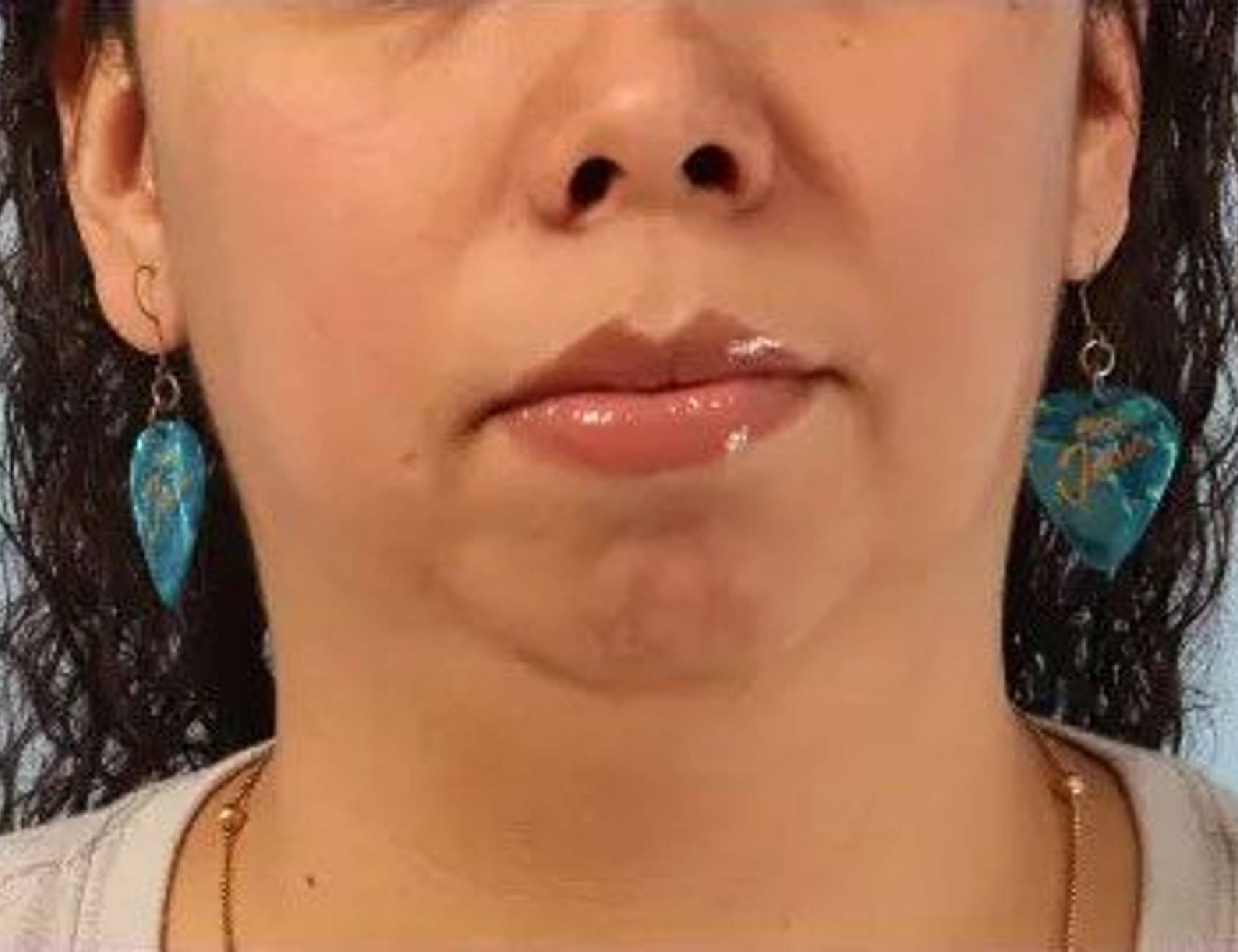 Augmentation Genioplasty Before & After Image
