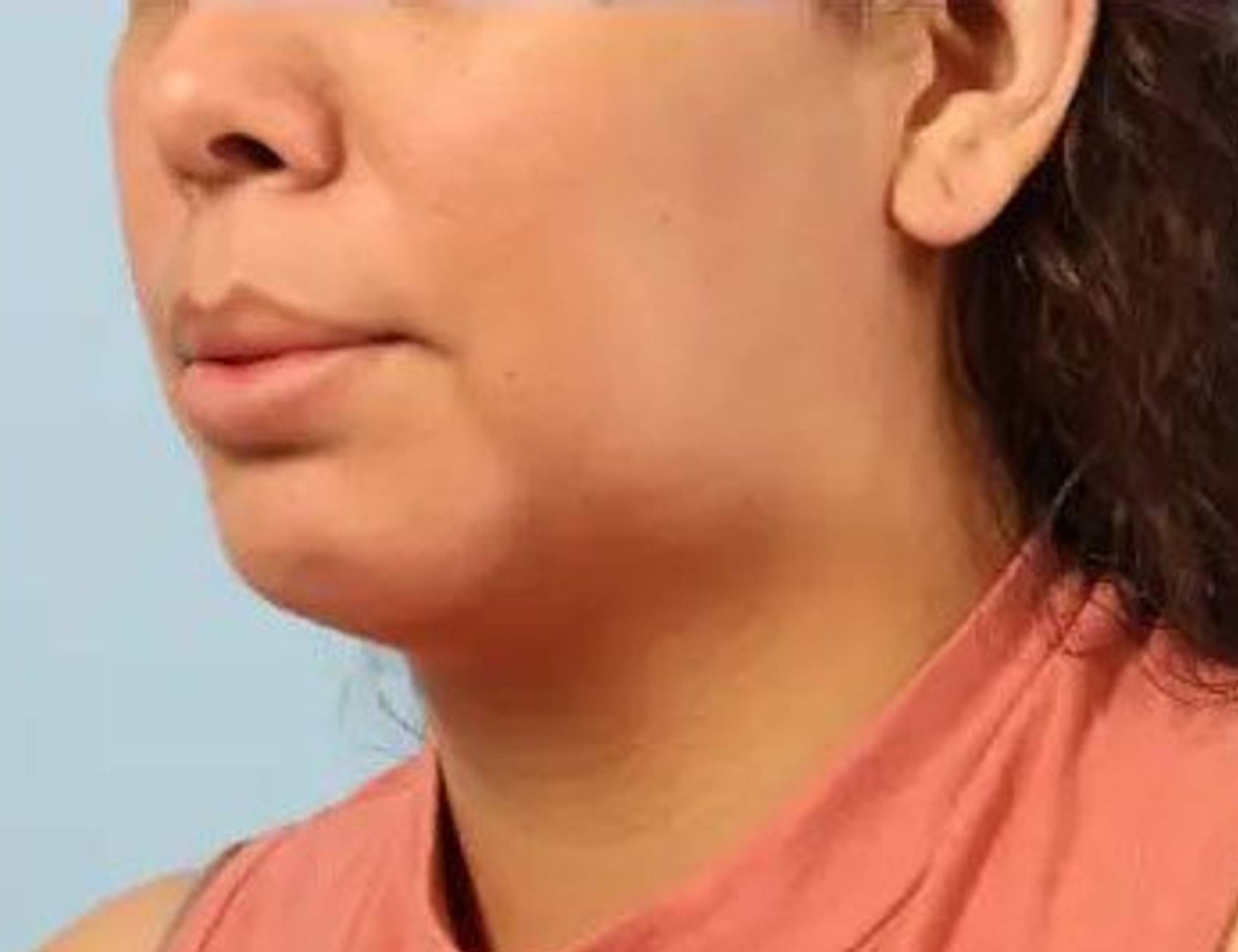 Augmentation Genioplasty Before & After Image