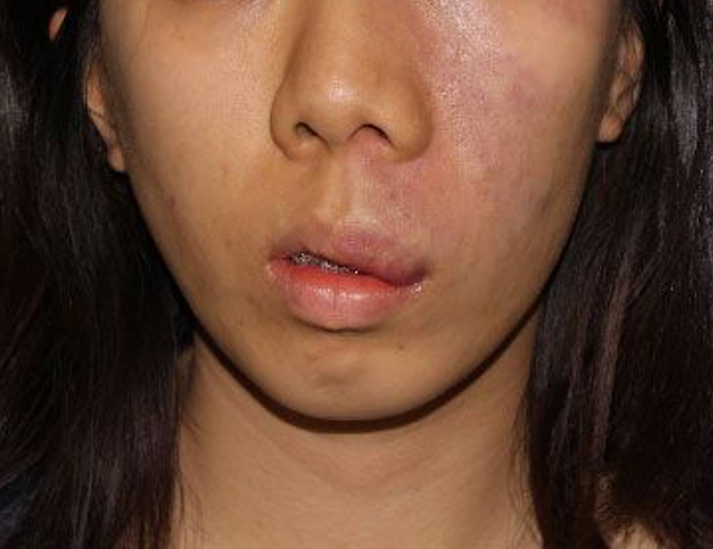 Augmentation Genioplasty Before & After Image