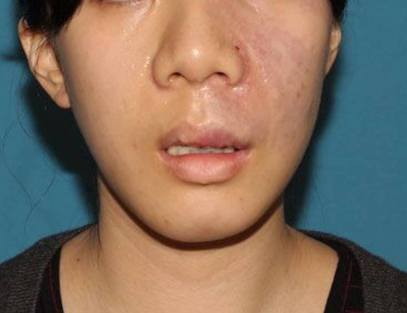 Augmentation Genioplasty Before & After Image