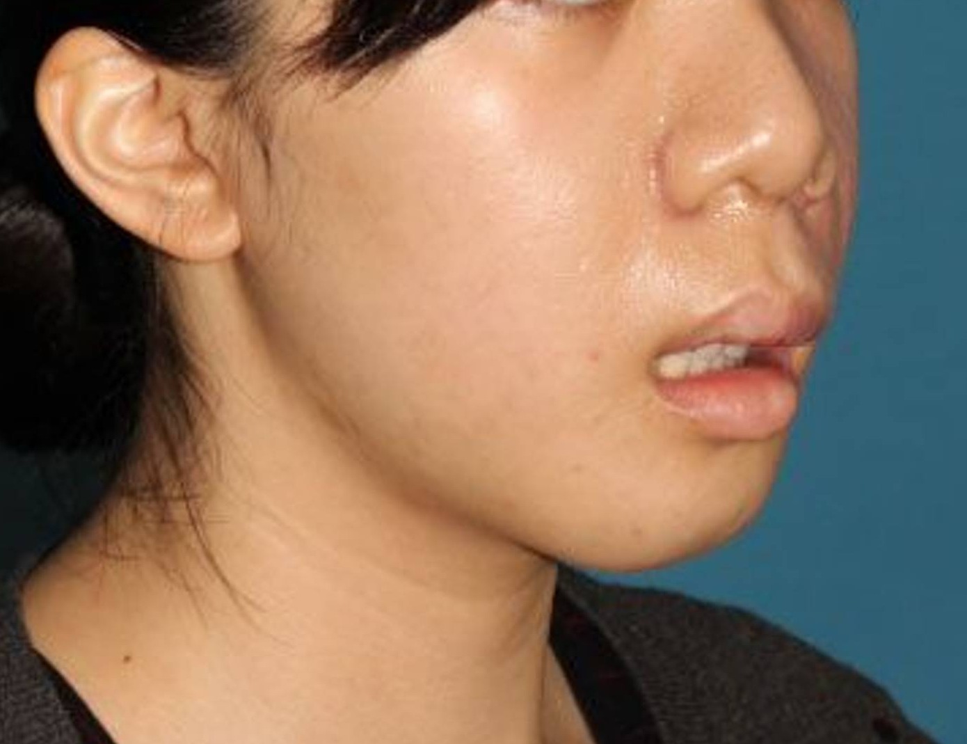 Augmentation Genioplasty Before & After Image