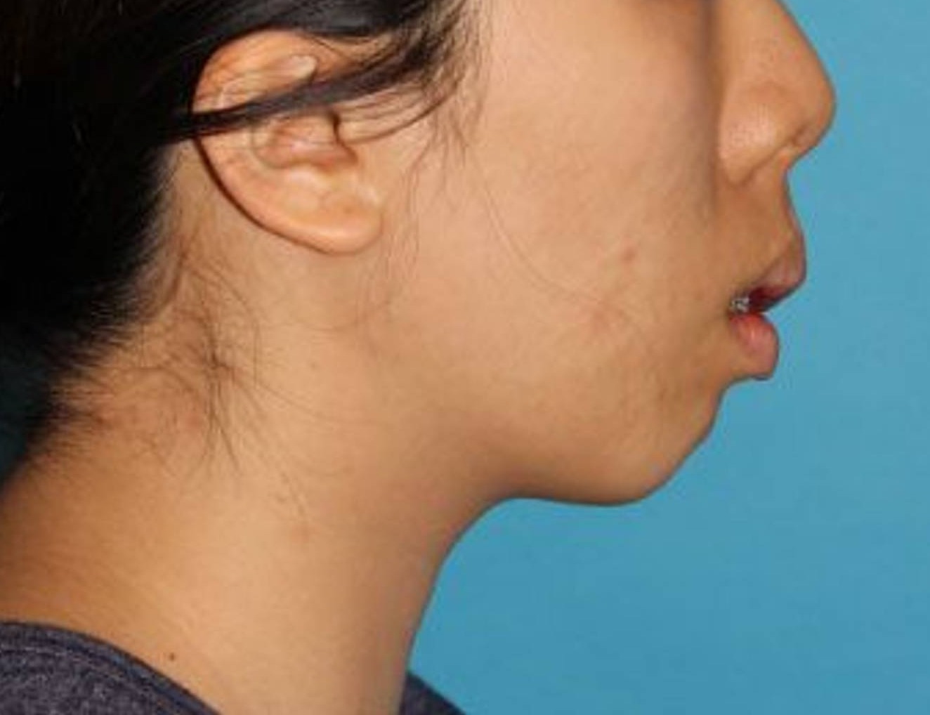 Augmentation Genioplasty Before & After Image