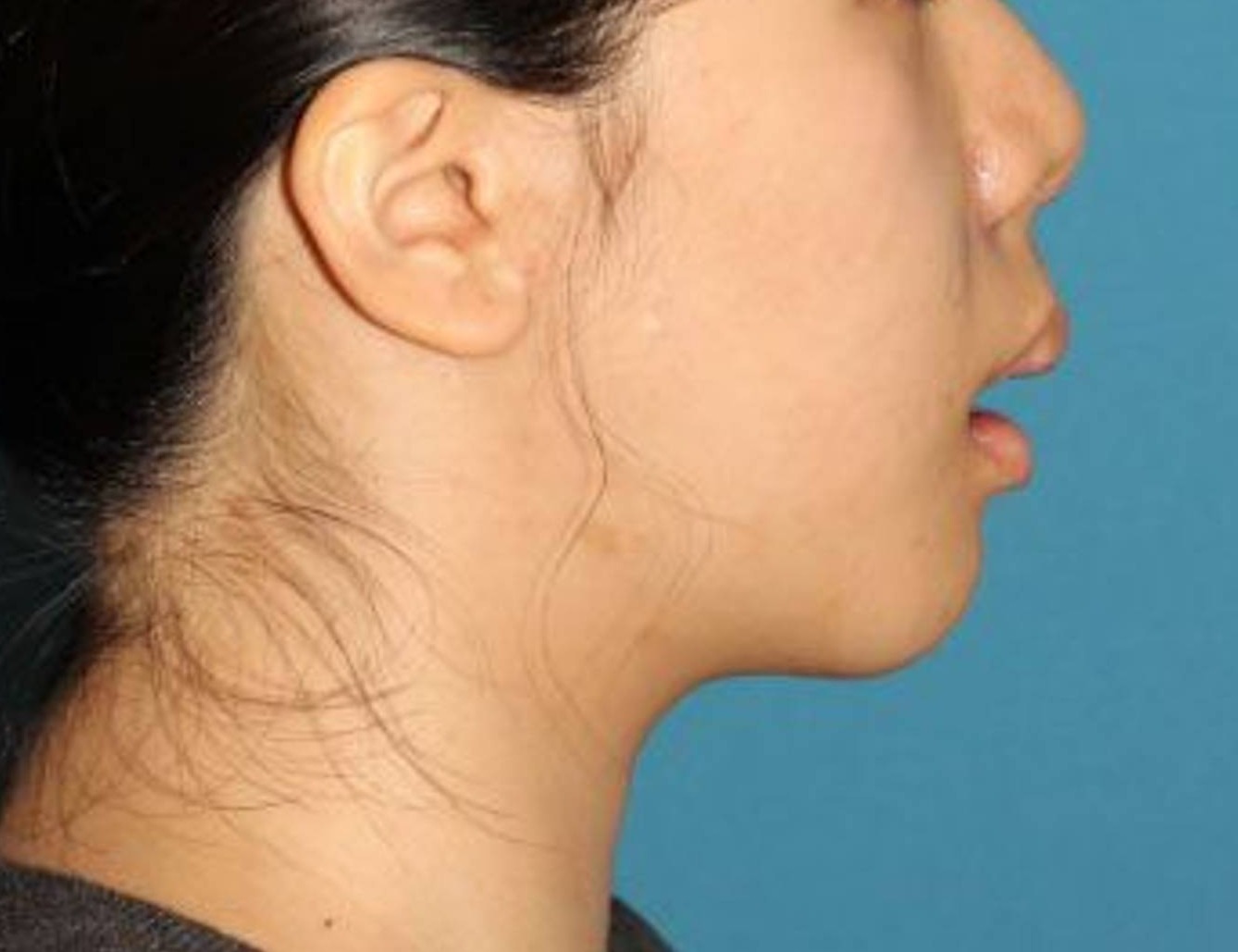 Augmentation Genioplasty Before & After Image