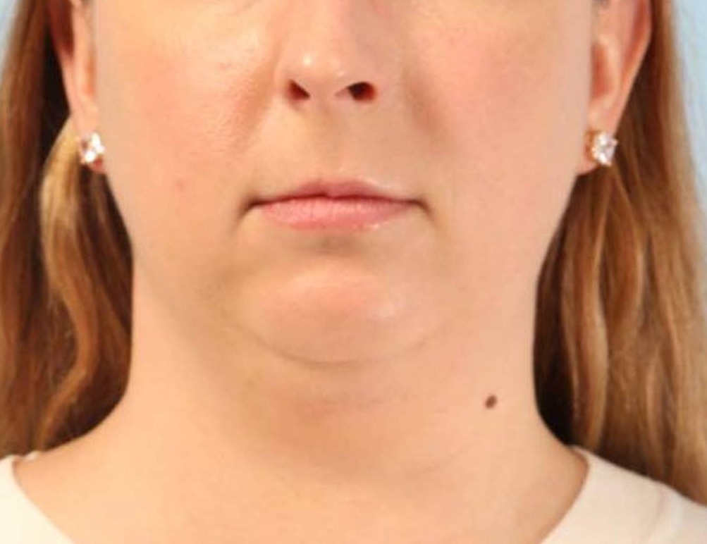 Augmentation Genioplasty Before & After Image